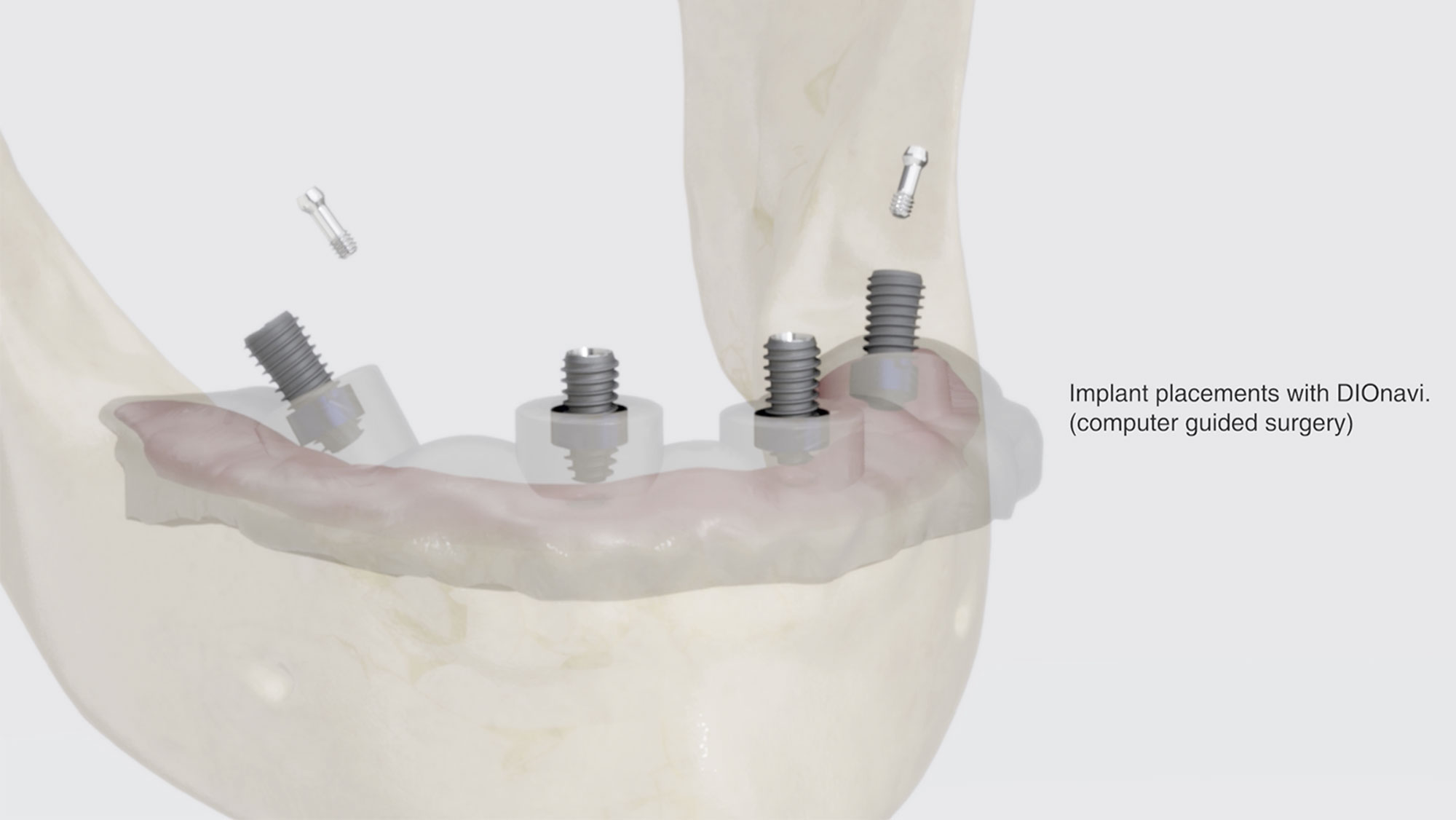 インプラント治療 – 高根デンタルクリニック