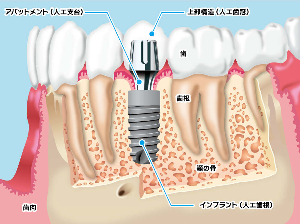 インプラント治療の基本構造