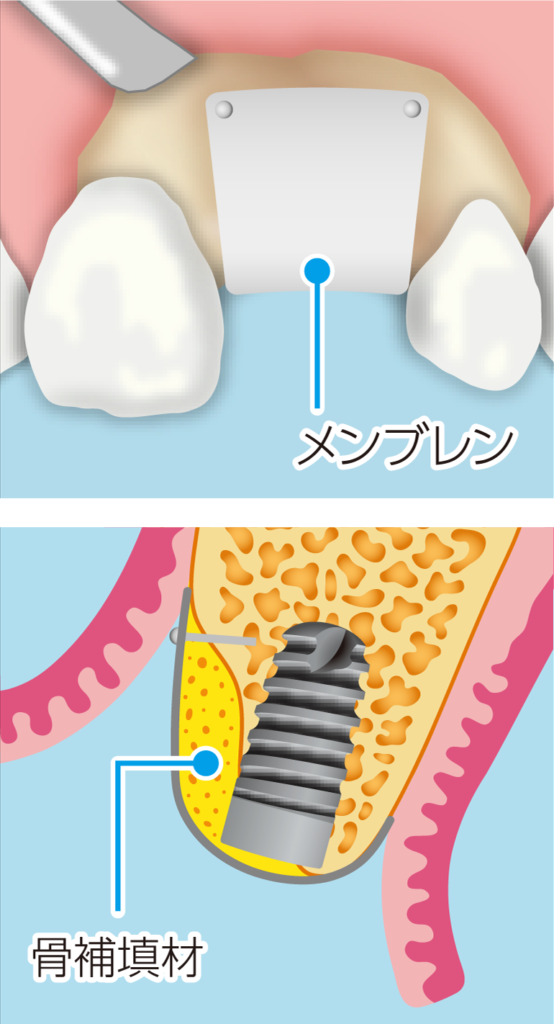 骨が不足している部分にメンブレンをかぶせます。