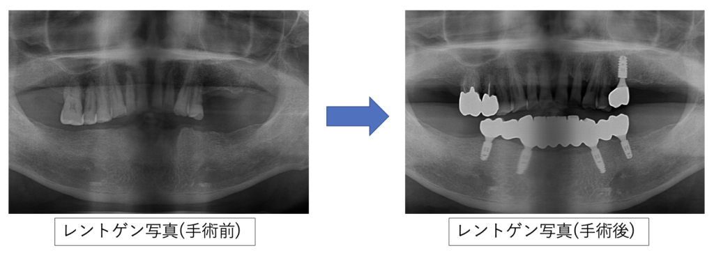 術前術後レントゲン