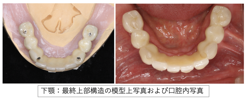 模型口腔内写真