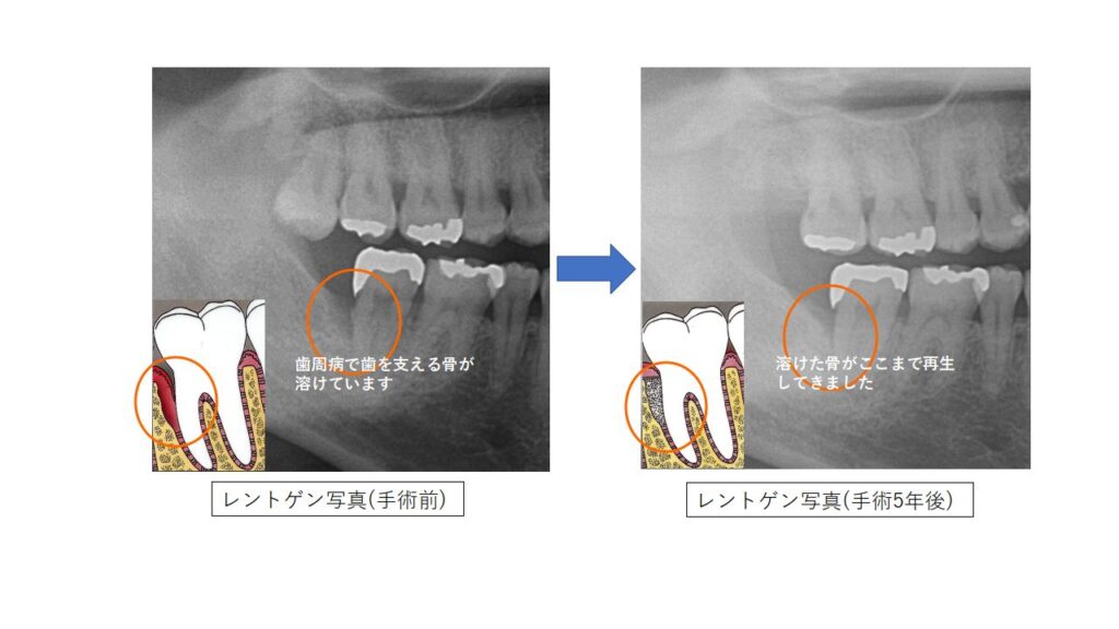 歯周病で溶けた骨を再生! 抜歯を防ぎしっかり噛めるようになった歯周組織再生療法の症例